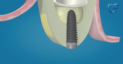 elevacion seno colocacion implante dental