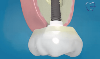 implante con elevacion de seno maxilar