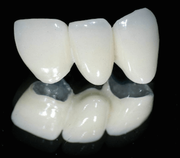 precio final de un implante dental