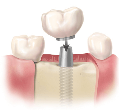  4 claves para comparar el precio final de un implante dental - Clínica dental Dr. Ferrer | Madrid