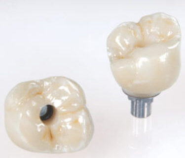 corona implante dental