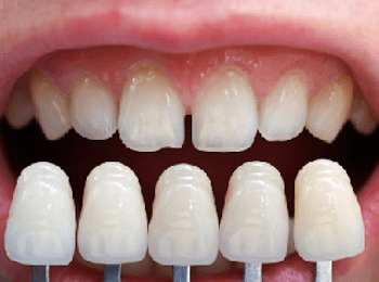 Estetica carillas dentales