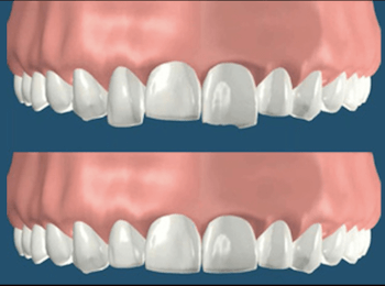 Corregir dientes irregulares