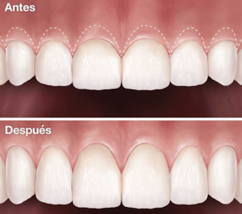 Remodelación estética de las encías