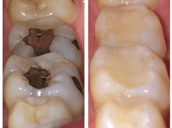 Empastes de composite y amalgama