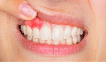 necesitas un dentista periodoncista