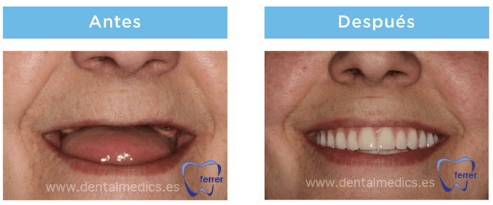 antes y despues protesis dental hibrida