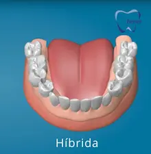 Prótesis dental híbrida sobre implantes para recuperar función masticatoria y estética