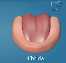 recuperar dientes con implantes