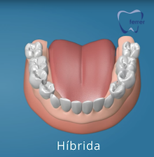 Colocación protesis dental hibrida