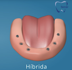 protesis hibrida con implantes