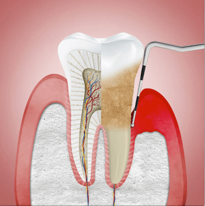 periodontitis soluciones de tratamiento