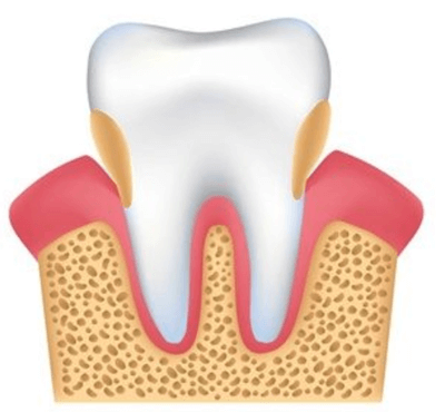  Tratamiento de la enfermedad periodontal - Clínica dental Dr. Ferrer | Madrid