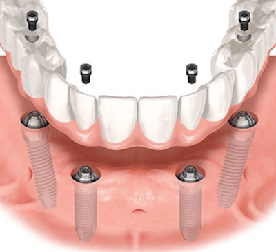  ¿Cual es el precio de una prótesis dental híbrida? - Clínica dental Dr. Ferrer | Madrid