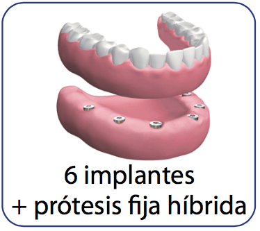 precio prótesis dental híbrida