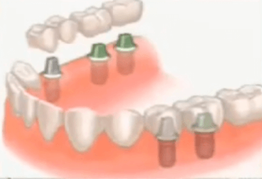 Implante dental o puente fijo madrid