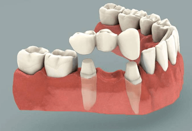 Implante dental o Puente fijo solucion 2 implantes