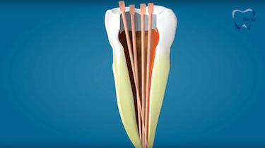 endodoncia multiradicular limpiar conductos