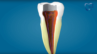 endodoncia multirradicular nervios duele