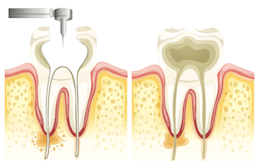 endodoncia multirradicular