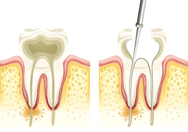 endodoncia multirradicular proceso