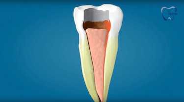 endodoncia multiradicular segunda fase