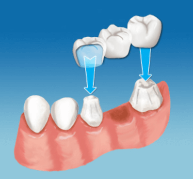  Implante dental o Puente fijo - Clínica dental Dr. Ferrer | Madrid