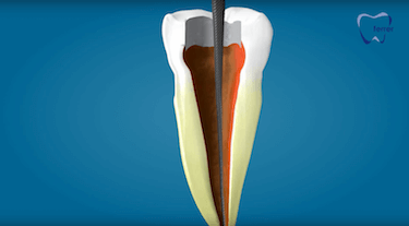 endodoncia multirradicular limas