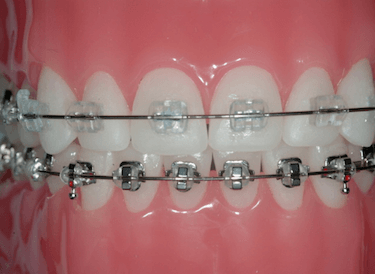 brackets de zafiro y metalicos