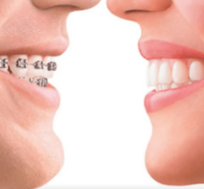  Ortodoncia estética con brackets de zafiro - Clínica dental Dr. Ferrer | Madrid