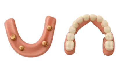 Sobredentadura sobre 4 implantes vista superior, precio del tratamiento en clínica Dr. Ferrer