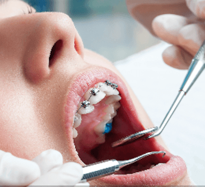  7 recomendaciones de higiene dental con Ortodoncia - Clínica dental Dr. Ferrer | Madrid