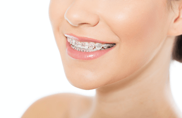 higiene dental brackets