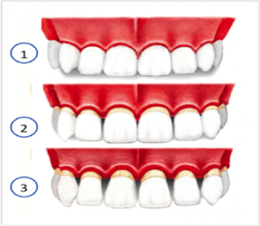 Periodoncia avanzada ultima etapa