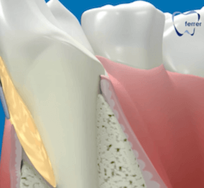  La periodontitis avanzada: síntomas y tratamiento - Clínica dental Dr. Ferrer | Madrid