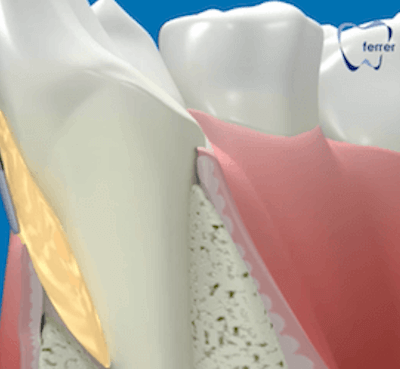  La periodontitis avanzada o piorrea: síntomas y tratamiento - Clínica dental Dr. Ferrer | Madrid