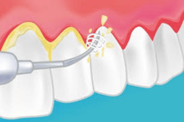 precio de un curetaje dental por cuadrante
