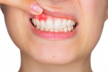 periodontitis avanzada encias