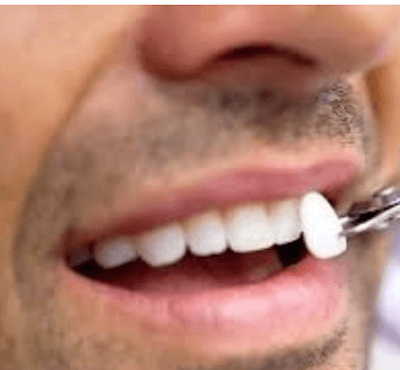  Tipos y precio de carillas dentales - Clínica dental Dr. Ferrer | Madrid