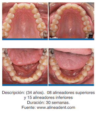 antes y despues y ortodoncia