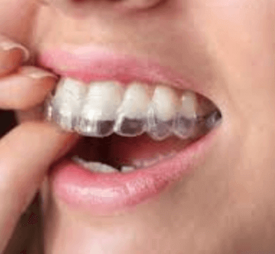  Alineadent ortodoncia transparente. Opinión y experiencia - Clínica dental Dr. Ferrer | Madrid