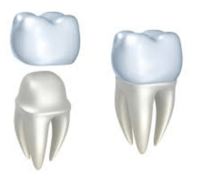  Fundas dentales: tipos y precio - Clínica dental Dr. Ferrer | Madrid