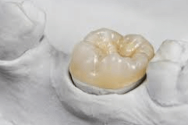 fundas y coronas dentales