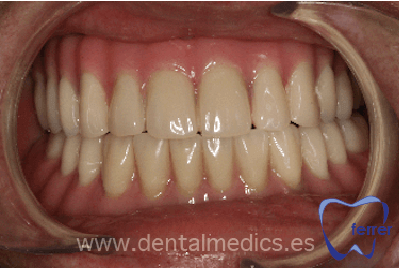 prótesis dental fija con implantes Dr Ferrer