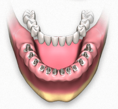  Prótesis dental fija con implantes dentales - Clínica dental Dr. Ferrer | Madrid