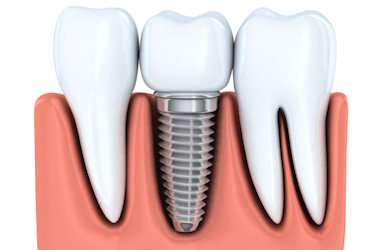 cirugia de implantes dentales