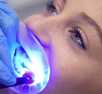  Preguntas frecuentes blanqueamiento dental en clínica - Clínica dental Dr. Ferrer | Madrid