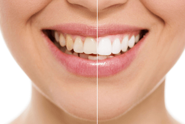 blanqueamiento dental en clínica