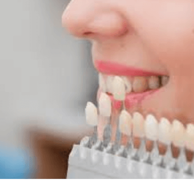  Carillas dentales de composite - Clínica dental Dr. Ferrer | Madrid
