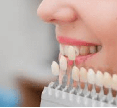  Carillas de composite: qué son, ventajas y precio - Clínica dental Dr. Ferrer | Madrid